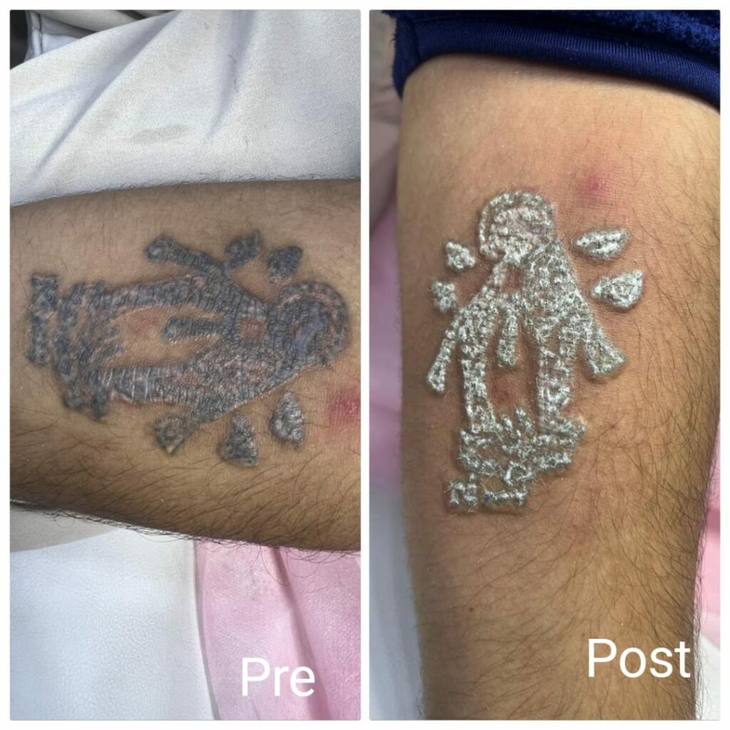 إزالة الوشم في الغردقة